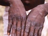 First Case of Monkeypox Virus Detected in United States This Year